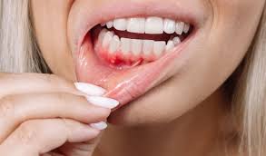 Mouth ulcers